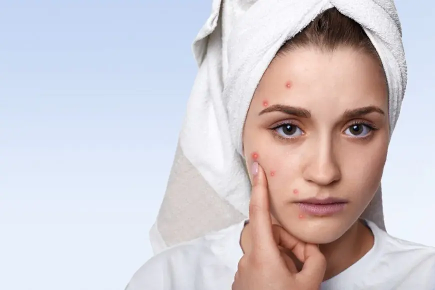 Acne Treatment: Exploring Natural Solutions for Clearer Skin